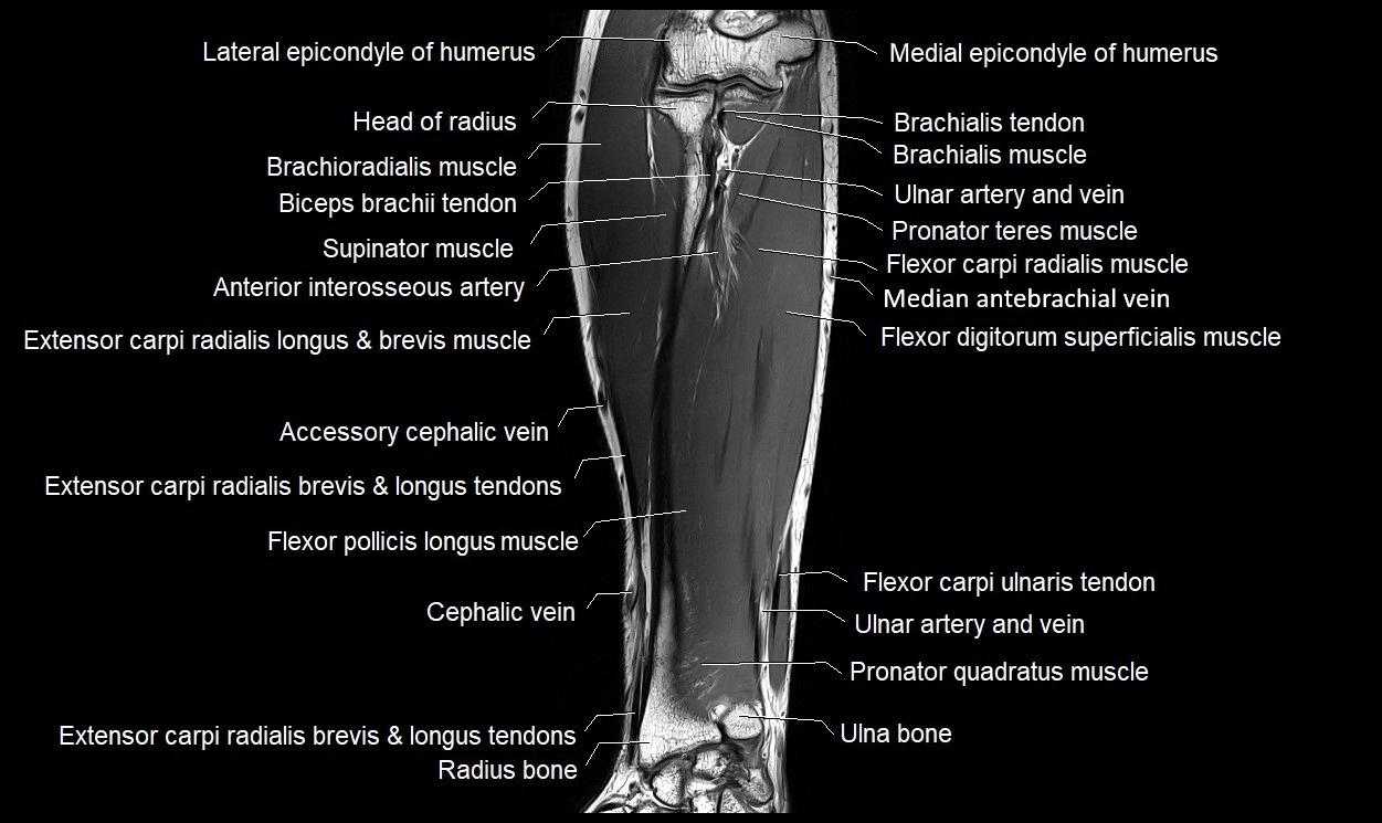 MRI 3T forearm coronal cross sectional anatomy image 13.webp